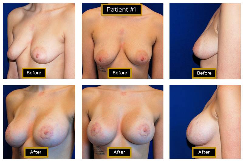 Dr. Marc Wetherington in Rome, GA, is the area leader in breast lifts 29