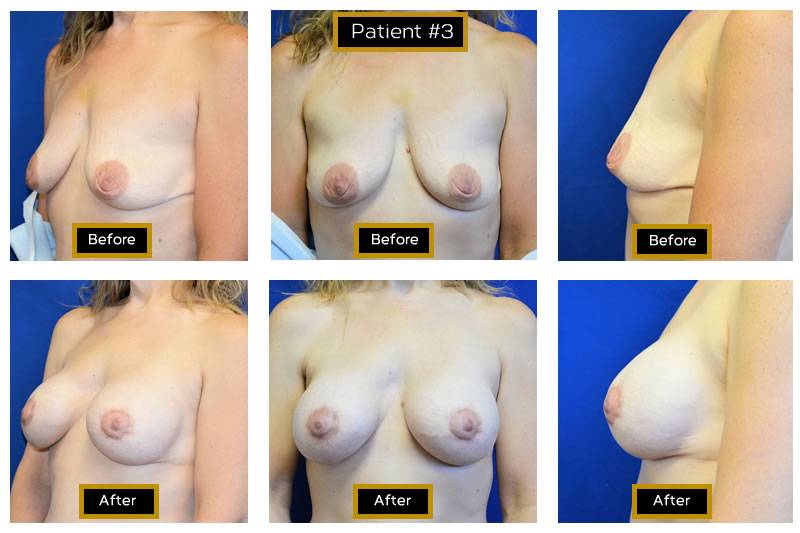 Dr. Marc Wetherington in Rome, GA, is the area leader in breast lifts 27