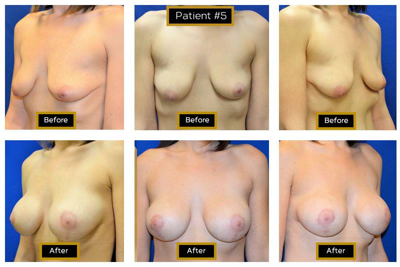 Dr. Marc Wetherington in Rome, GA, is the area leader in breast lifts 25