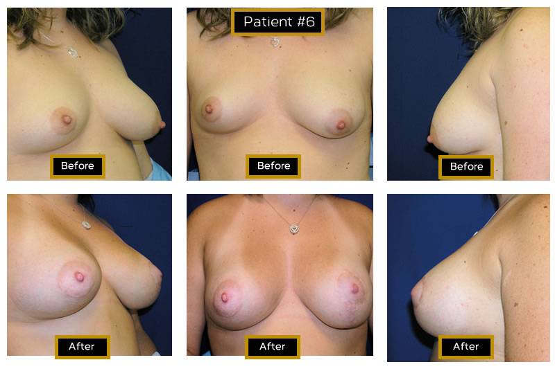 Dr. Marc Wetherington in Rome, GA, is the area leader in breast lifts 24