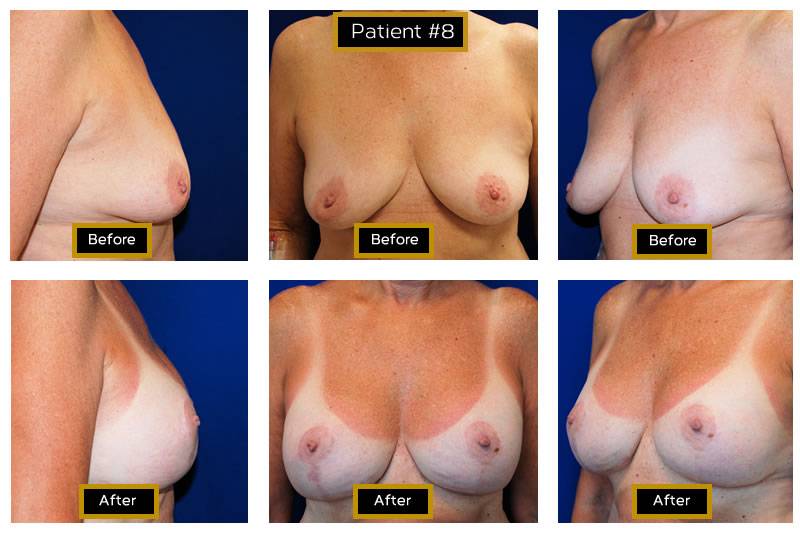 Dr. Marc Wetherington in Rome, GA, is the area leader in breast lifts 22