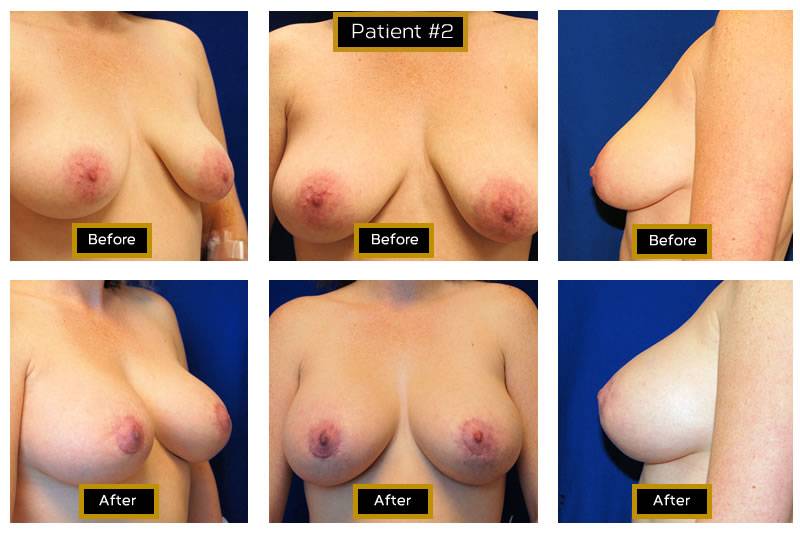 Dr. Marc Wetherington in Rome, GA, is the area leader in breast lifts 7