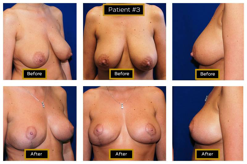 Dr. Marc Wetherington in Rome, GA, is the area leader in breast lifts 6