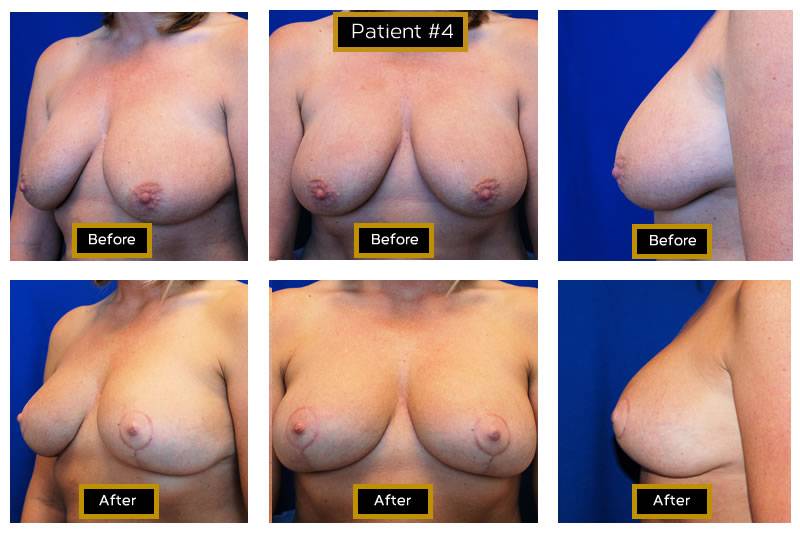 Dr. Marc Wetherington in Rome, GA, is the area leader in breast lifts 5