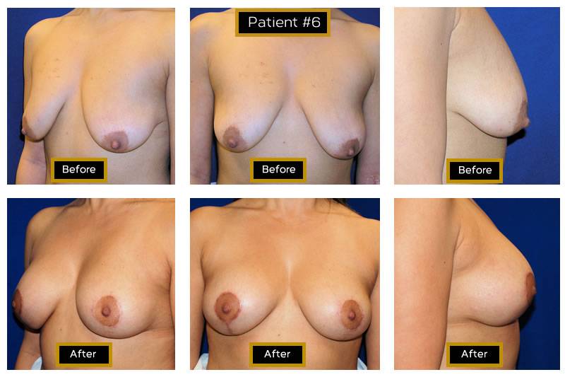 Dr. Marc Wetherington in Rome, GA, is the area leader in breast lifts 4