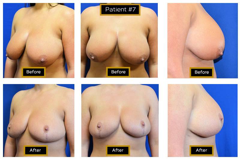 Dr. Marc Wetherington in Rome, GA, is the area leader in breast lifts 3