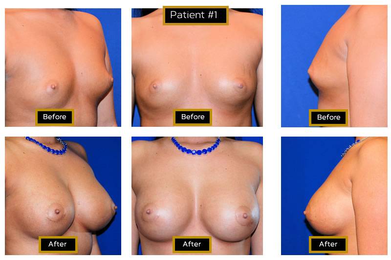Dr. Marc Wetherington in Rome, GA, is the area leader in breast augmentation 1