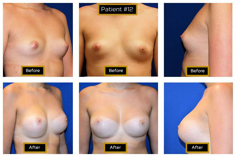 Dr. Marc Wetherington in Rome, GA, is the area leader in breast augmentation 12