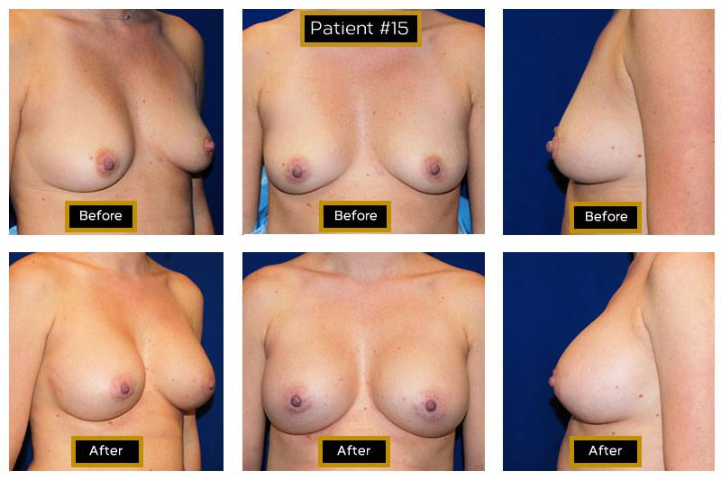 Dr. Marc Wetherington in Rome, GA, is the area leader in breast augmentation 15