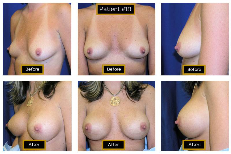 Dr. Marc Wetherington in Rome, GA, is the area leader in breast augmentation 18