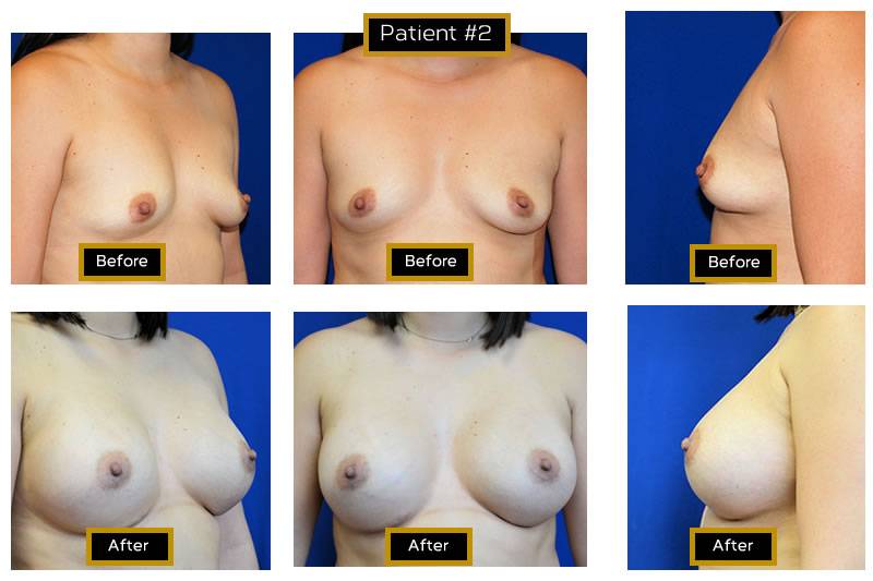 Dr. Marc Wetherington in Rome, GA, is the area leader in breast augmentation 2