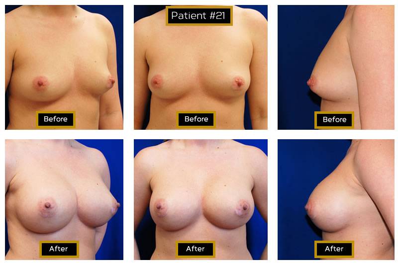 Dr. Marc Wetherington in Rome, GA, is the area leader in breast augmentation 21