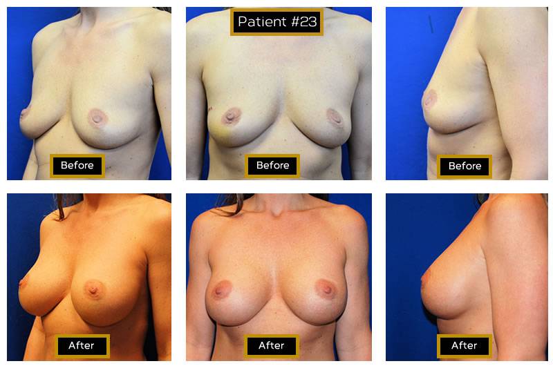 Dr. Marc Wetherington in Rome, GA, is the area leader in breast augmentation 23