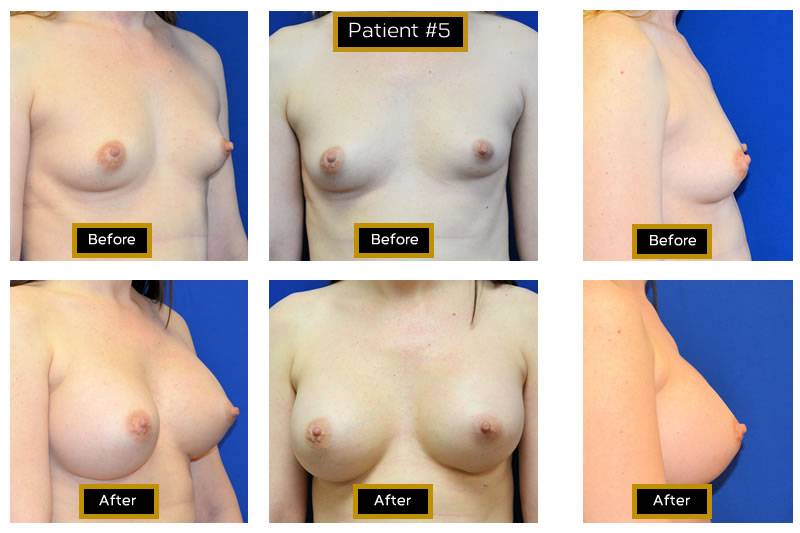 Dr. Marc Wetherington in Rome, GA, is the area leader in breast augmentation 5