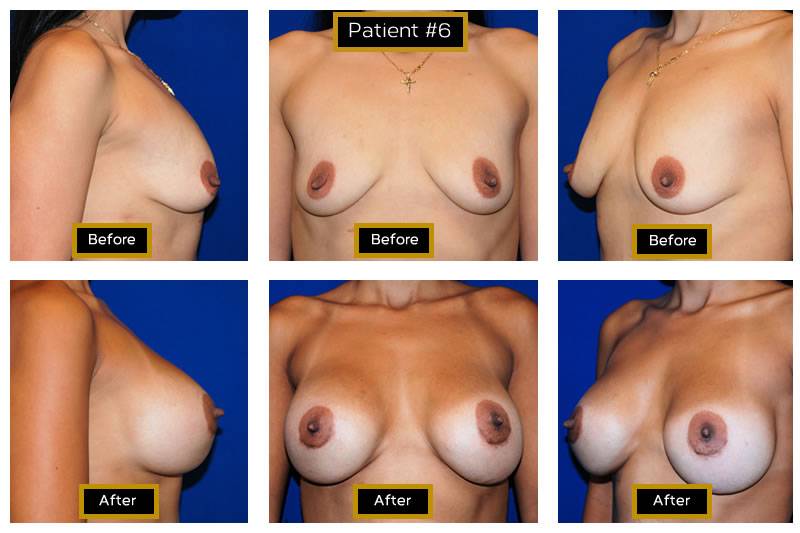 Dr. Marc Wetherington in Rome, GA, is the area leader in breast augmentation 6