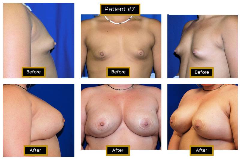 Dr. Marc Wetherington in Rome, GA, is the area leader in breast augmentation 7