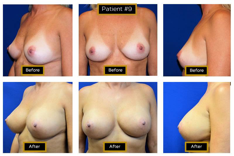 Dr. Marc Wetherington in Rome, GA, is the area leader in breast augmentation 9