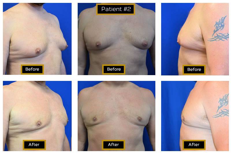 Dr. Marc Wetherington in Rome, GA, is the area leader in gynecomastia 3