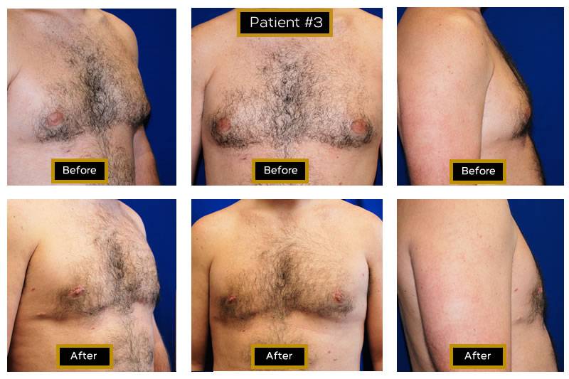 Dr. Marc Wetherington in Rome, GA, is the area leader in gynecomastia 2