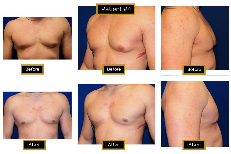 Dr. Marc Wetherington in Rome, GA, is the area leader in gynecomastia 1