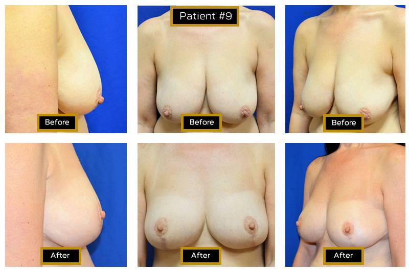 Dr. Marc Wetherington in Rome, GA, is the area leader in breast lifts 1