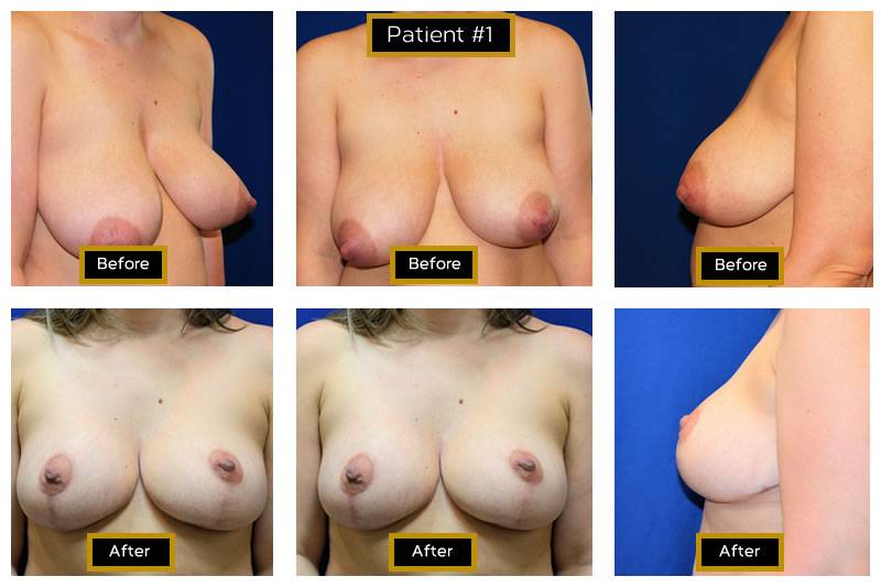Dr. Marc Wetherington in Rome, GA, is the area leader in breast lifts 20