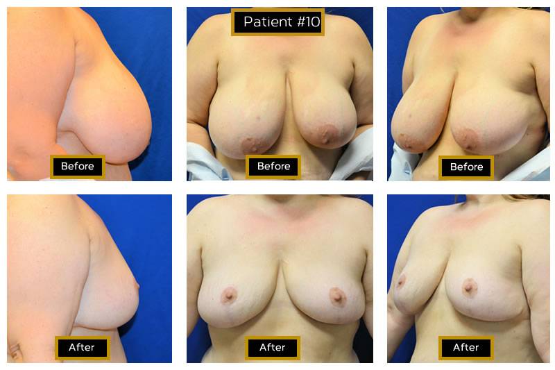 Dr. Marc Wetherington in Rome, GA, is the area leader in breast lifts 11