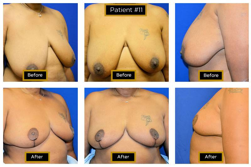 Dr. Marc Wetherington in Rome, GA, is the area leader in breast lifts 10