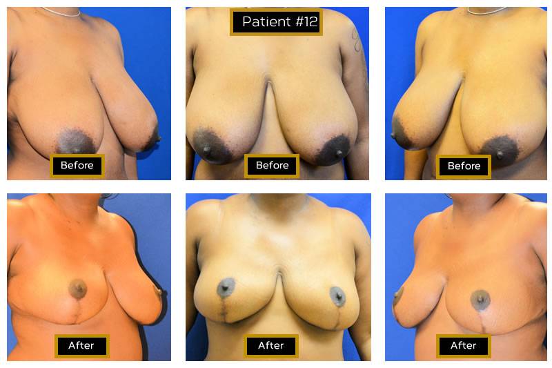 Dr. Marc Wetherington in Rome, GA, is the area leader in breast lifts 9