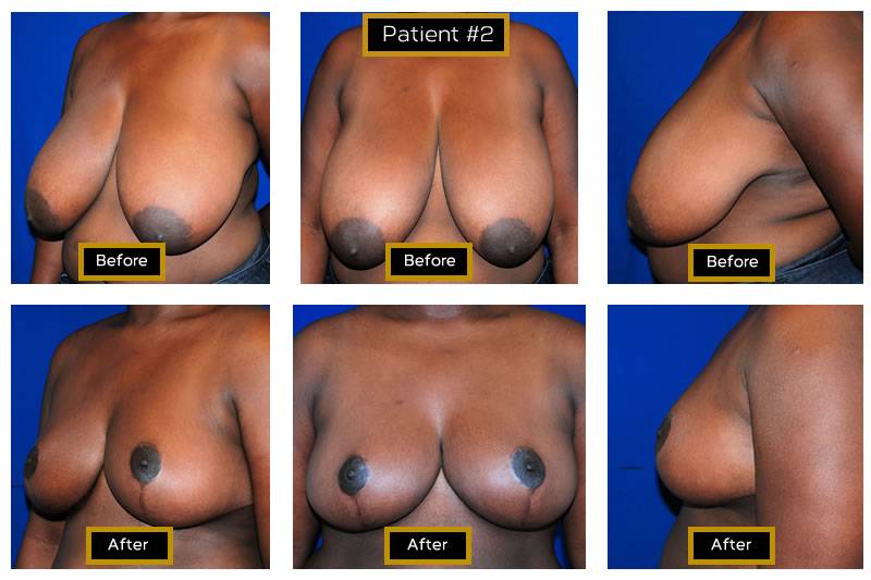 Dr. Marc Wetherington in Rome, GA, is the area leader in breast lifts 19