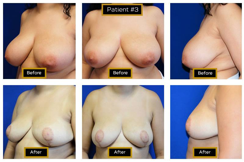 Dr. Marc Wetherington in Rome, GA, is the area leader in breast lifts 18