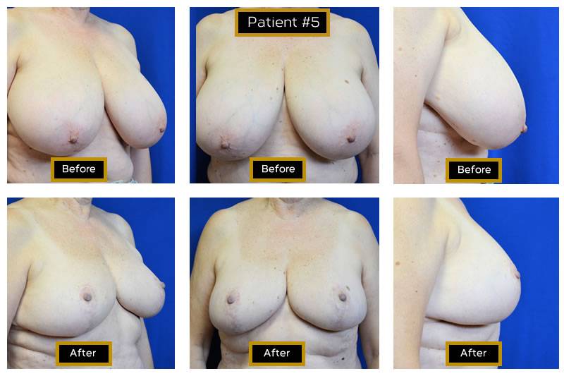 Dr. Marc Wetherington in Rome, GA, is the area leader in breast lifts 16