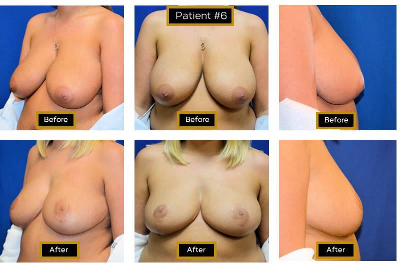 Dr. Marc Wetherington in Rome, GA, is the area leader in breast lifts 15