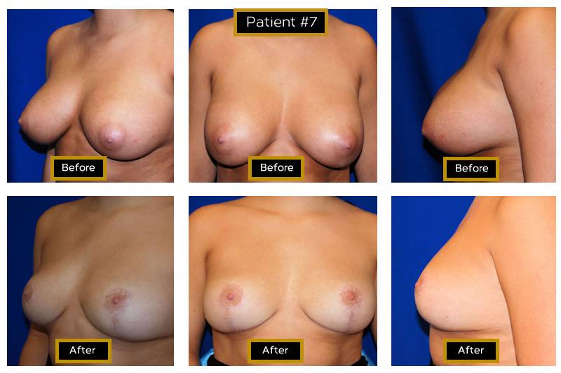 Dr. Marc Wetherington in Rome, GA, is the area leader in breast lifts 14
