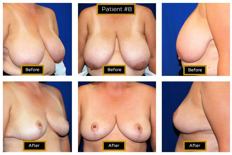Dr. Marc Wetherington in Rome, GA, is the area leader in breast lifts 13