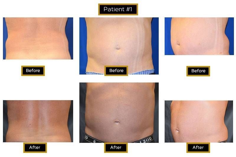 Dr. Marc Wetherington in Rome, GA, is the area leader in laser body contouring and SculpSure 3