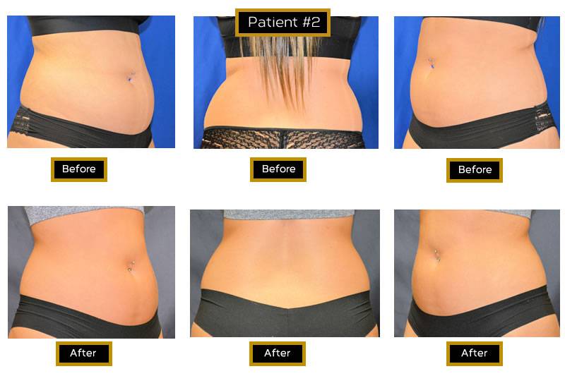 SculpSure before-andDr. Marc Wetherington in Rome, GA, is the area leader in laser body contouring and SculpSure 2-after photo #2