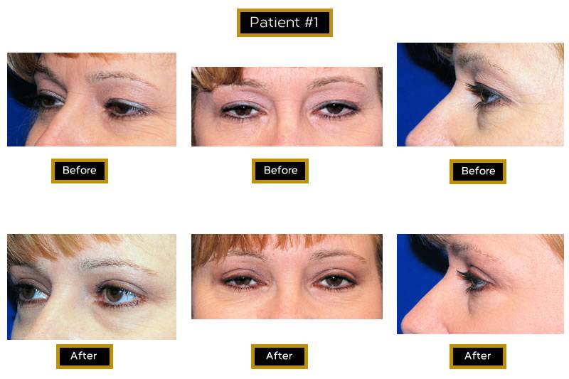Dr. Marc Wetherington in Rome, GA, is the area leader in upper eyelid lifts 7