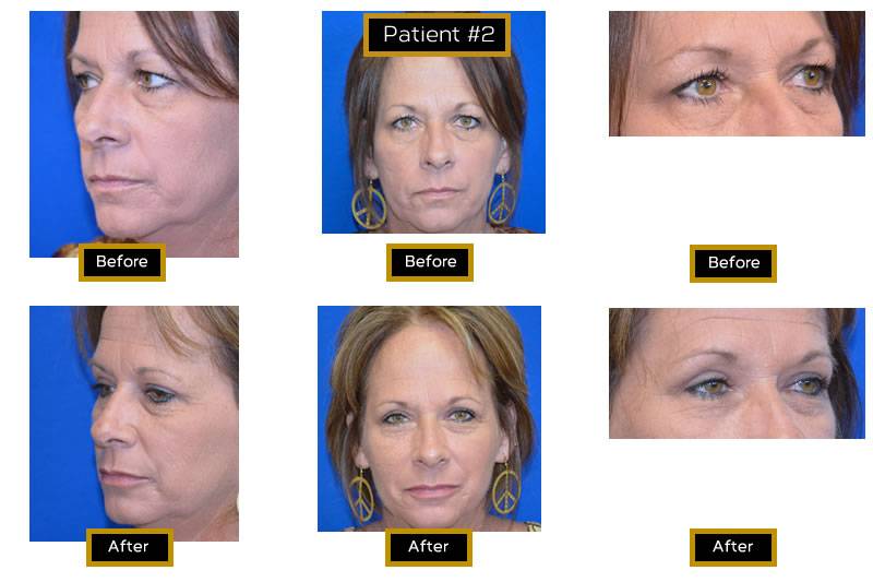 Dr. Marc Wetherington in Rome, GA, is the area leader in upper eyelid lifts 6