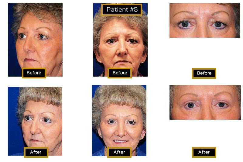 Dr. Marc Wetherington in Rome, GA, is the area leader in upper eyelid lifts 3
