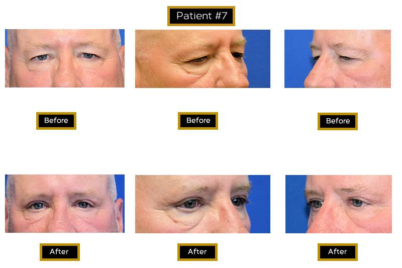 Dr. Marc Wetherington in Rome, GA, is the area leader in upper eyelid lifts 1