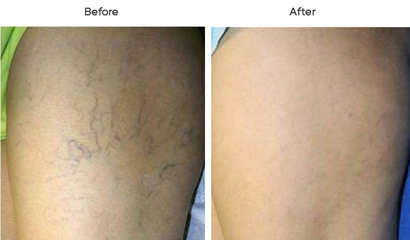 Dr. Marc Wetherington in Rome, GA, is the area leader in spider vein treatments 6