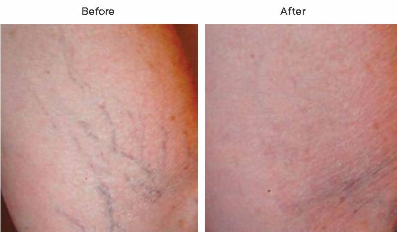 Dr. Marc Wetherington in Rome, GA, is the area leader in spider vein treatments 5