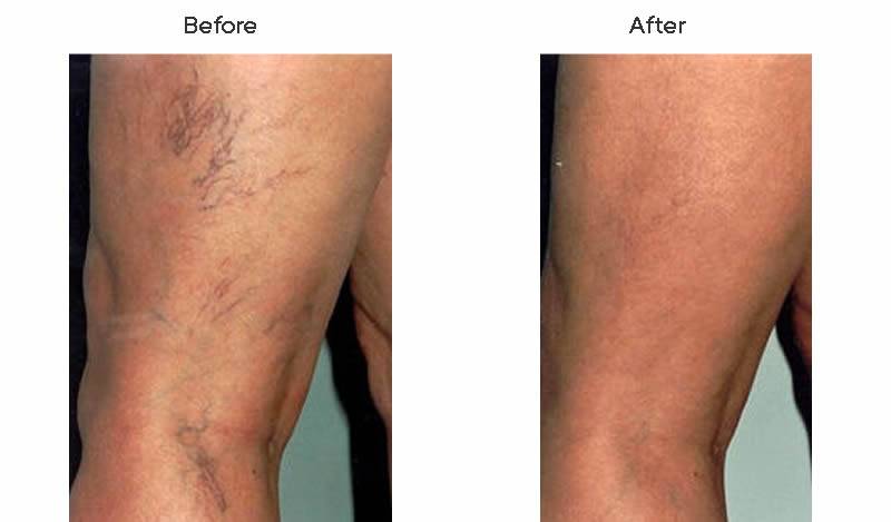 Dr. Marc Wetherington in Rome, GA, is the area leader in spider vein treatments 4