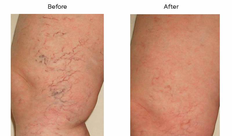 Dr. Marc Wetherington in Rome, GA, is the area leader in spider vein treatments 3