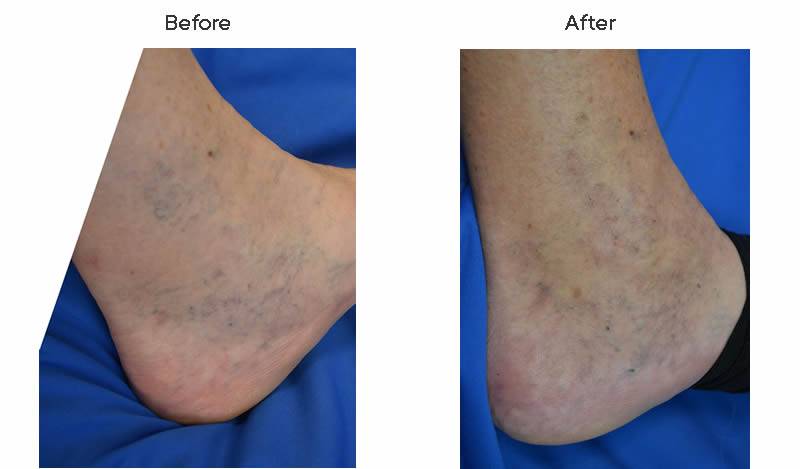 Dr. Marc Wetherington in Rome, GA, is the area leader in spider vein treatments 2