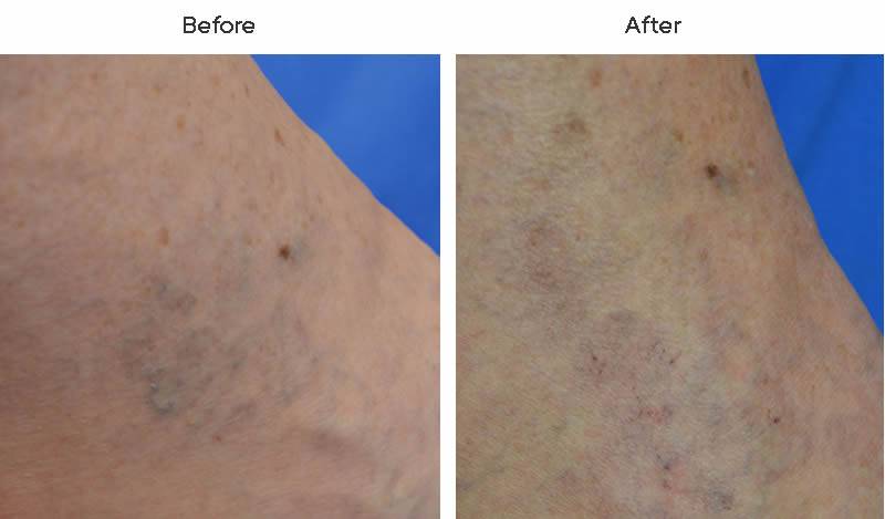 Dr. Marc Wetherington in Rome, GA, is the area leader in spider vein treatments 1