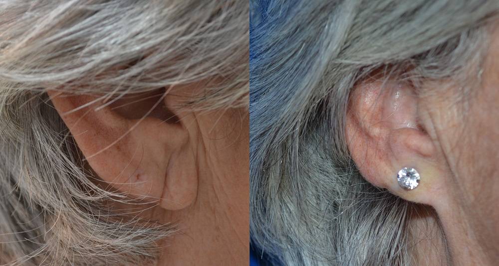 Dr. Marc Wetherington in Rome, GA, is the area leader in earlobe repair and reduction 2