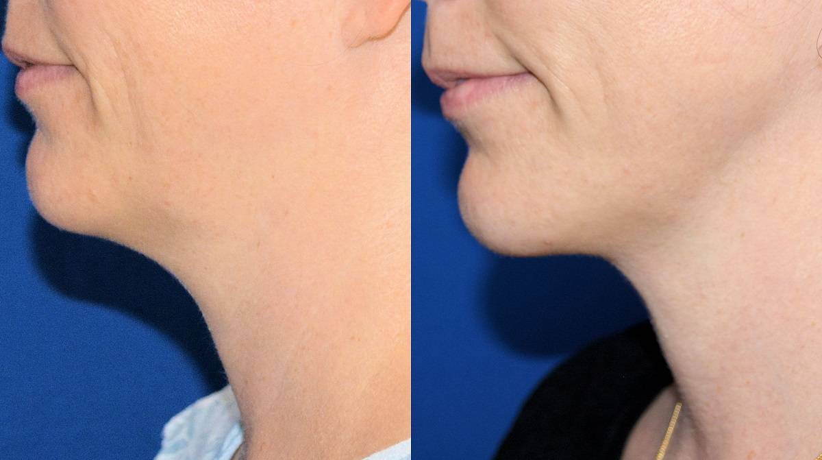 12 Dr. Marc Wetherington in Rome, GA, is the area leader in SmartLipo for the neck
