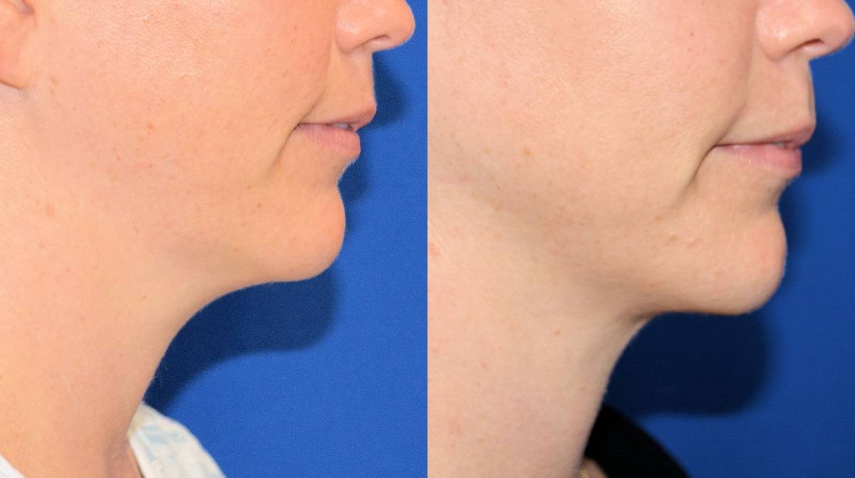 10 Dr. Marc Wetherington in Rome, GA, is the area leader in SmartLipo for the neck